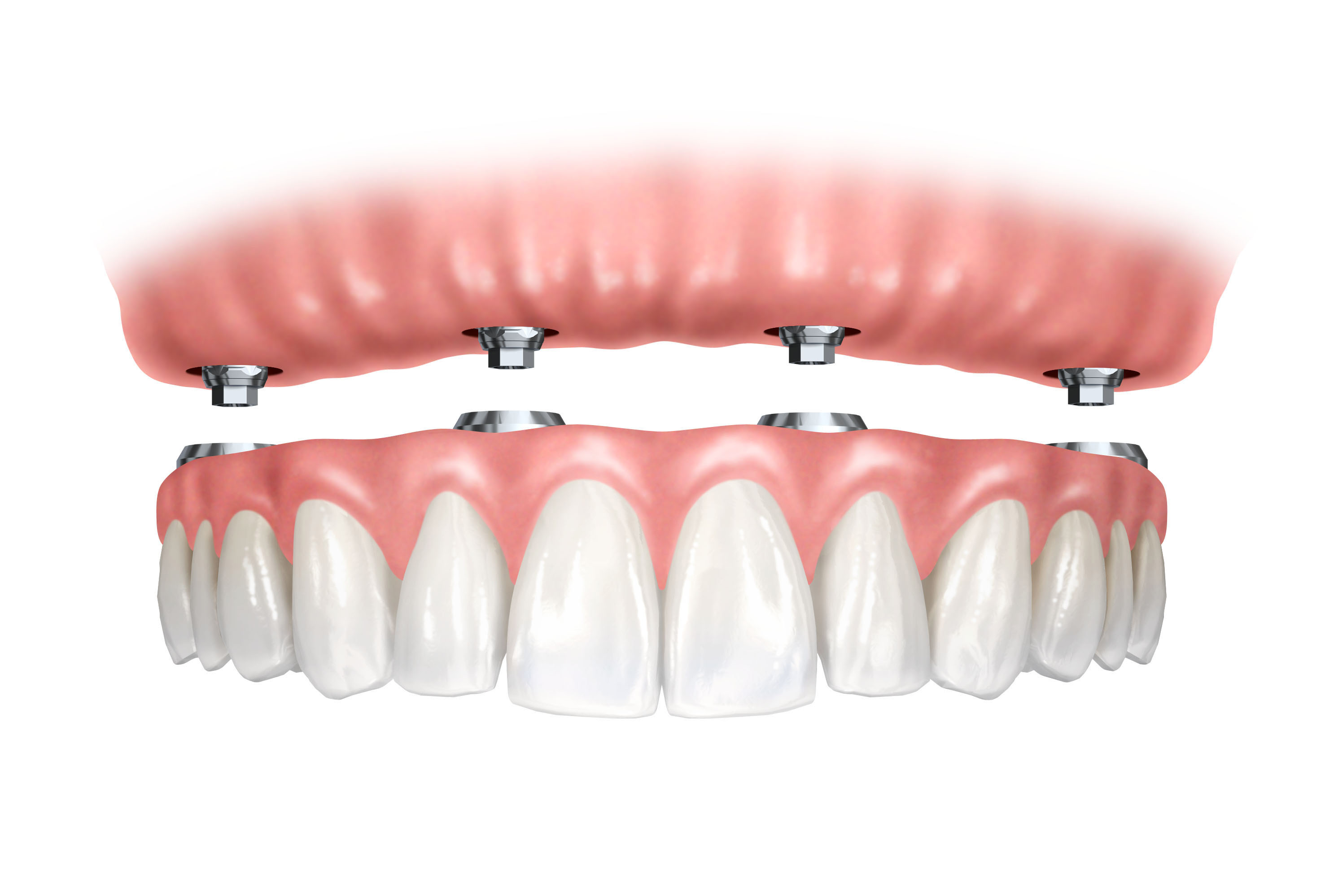 atlas-denture-centre-Implant-retained-denture